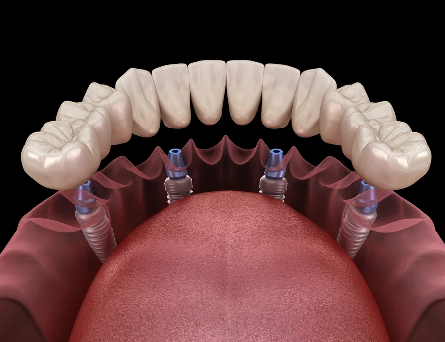 3D Digital image of dental prosthesis based on 4 implants.