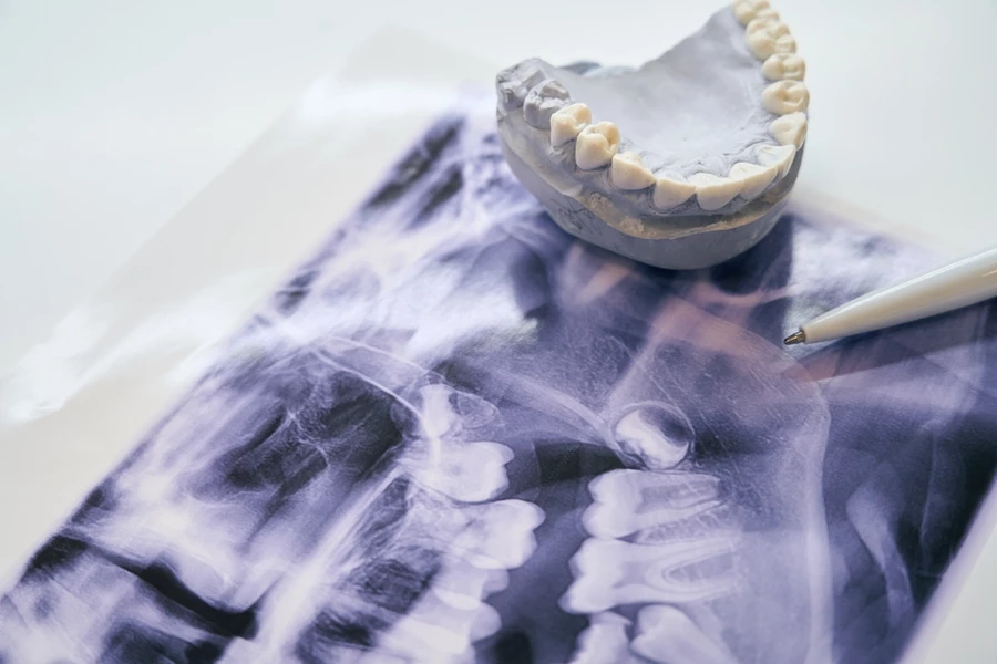 Dental mold on a table on top of x-ray of teeth