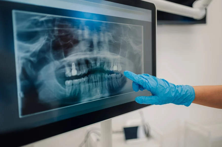Dentists hand wearing a glove pointing at an xray