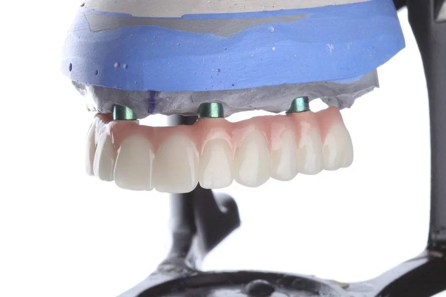 Model of a full arch dental implant